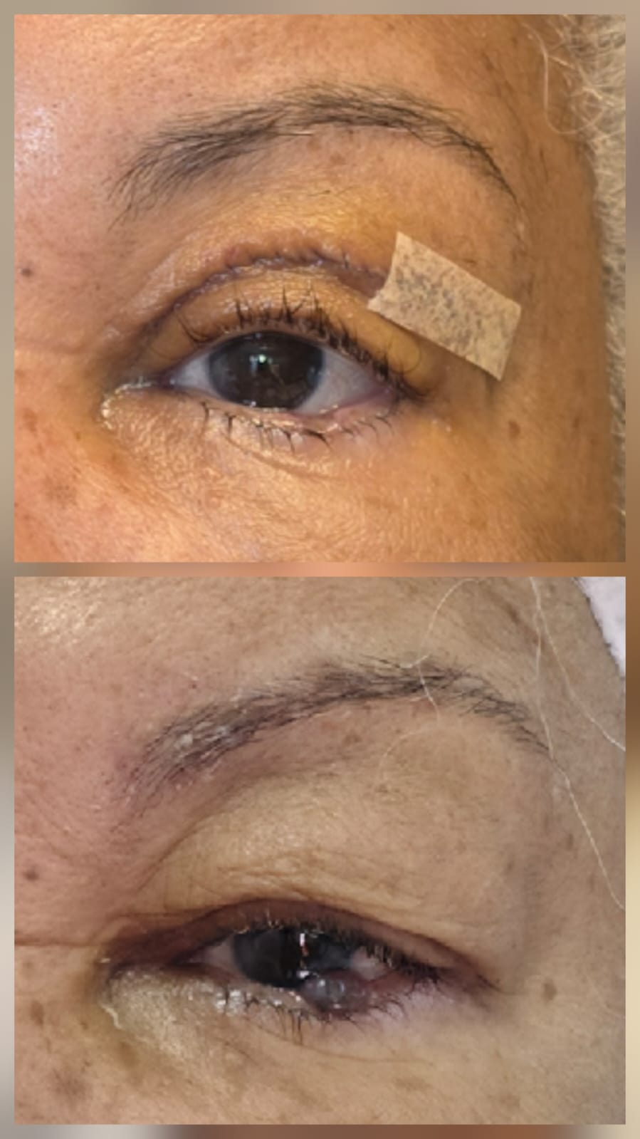 Resultado blefaroplastia - Antes e Depois 5