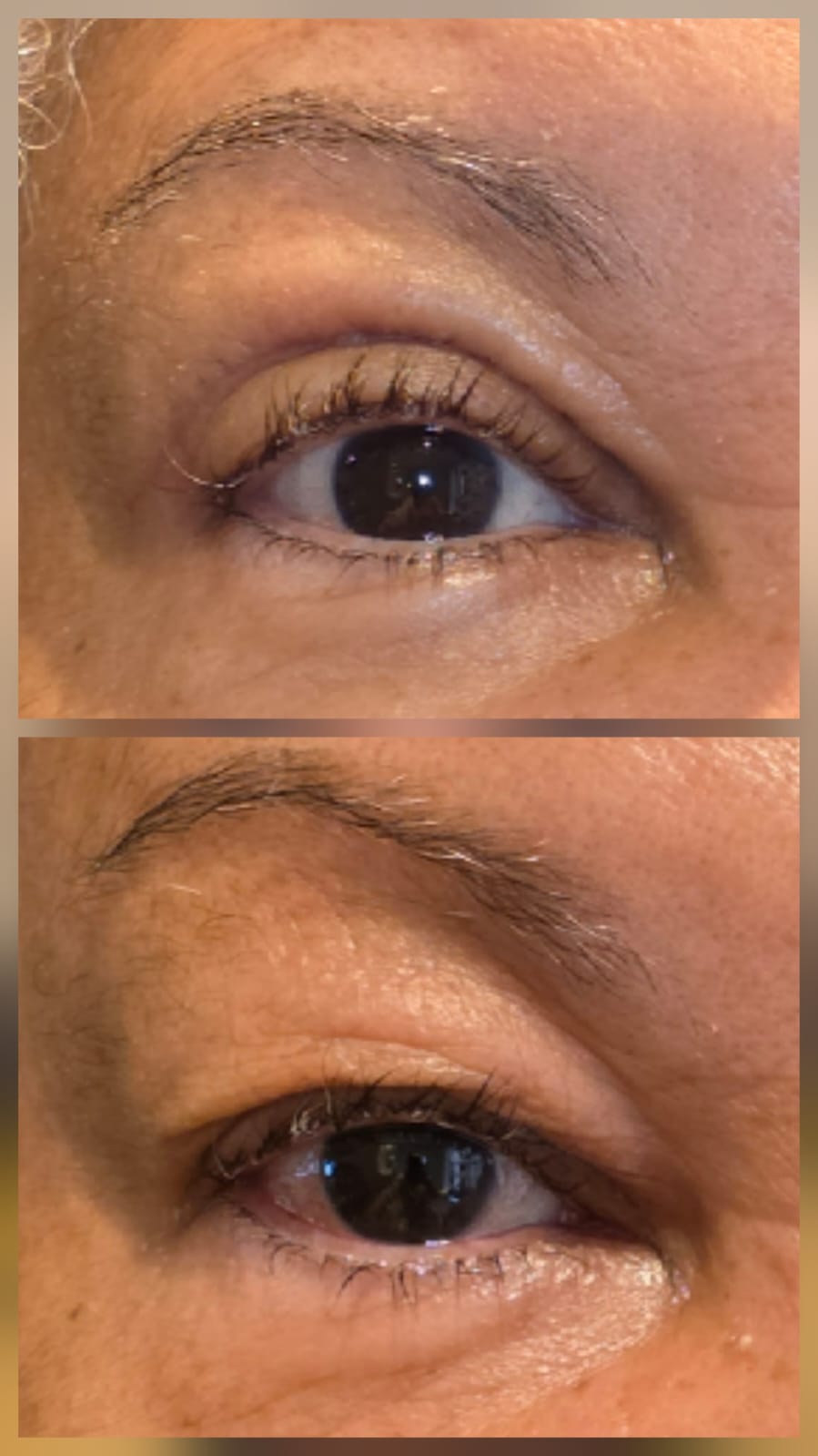 Resultado blefaroplastia - Antes e Depois 4