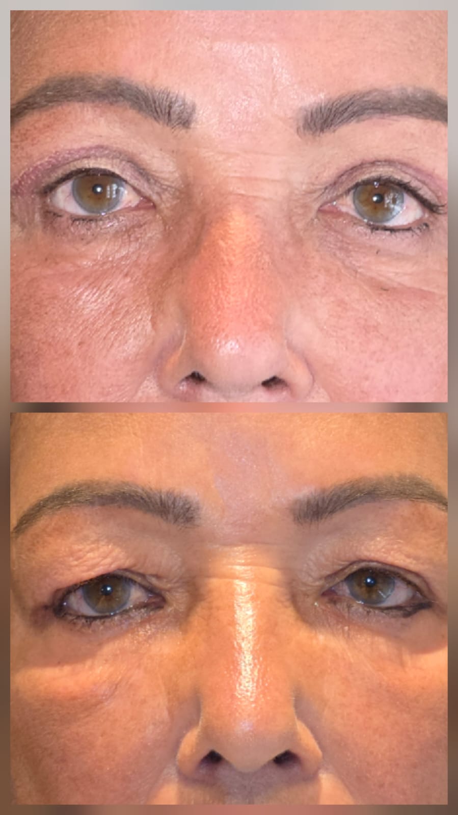 Resultado blefaroplastia - Antes e Depois 3