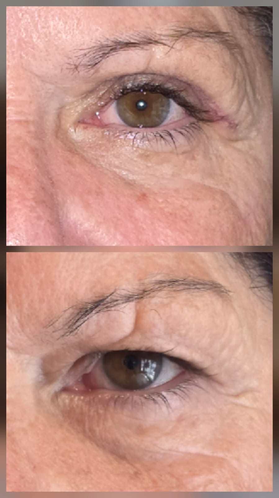 Resultado blefaroplastia - Antes e Depois 2